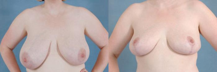 Before & After Breast Reduction Case 179 View #1 View in Tallahassee, FL