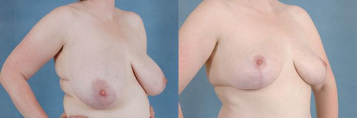 Before & After Breast Reduction Case 179 View #2 View in Tallahassee, FL