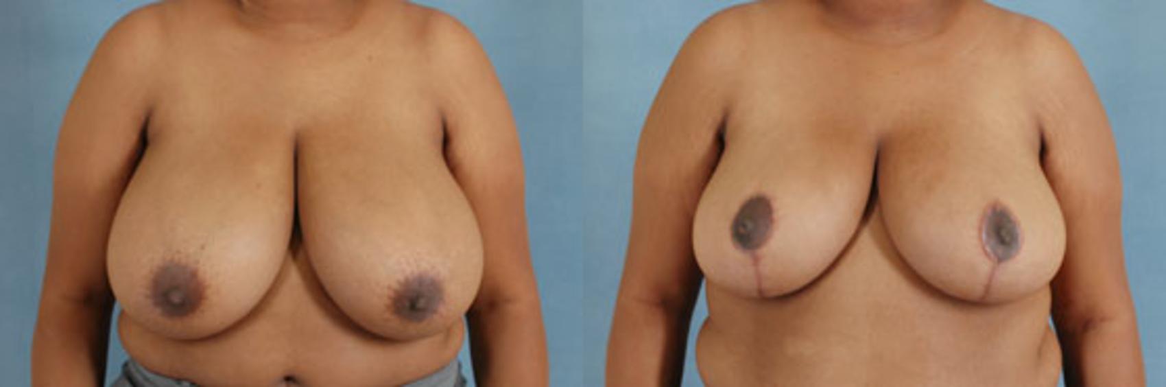 Before & After Breast Reduction Case 180 View #1 View in Tallahassee, FL