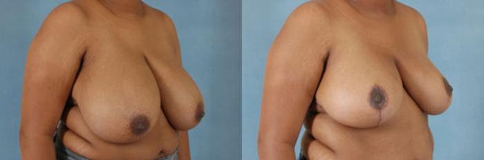 Before & After Breast Reduction Case 180 View #2 View in Tallahassee, FL