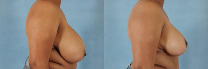 Before & After Breast Reduction Case 180 View #3 View in Tallahassee, FL