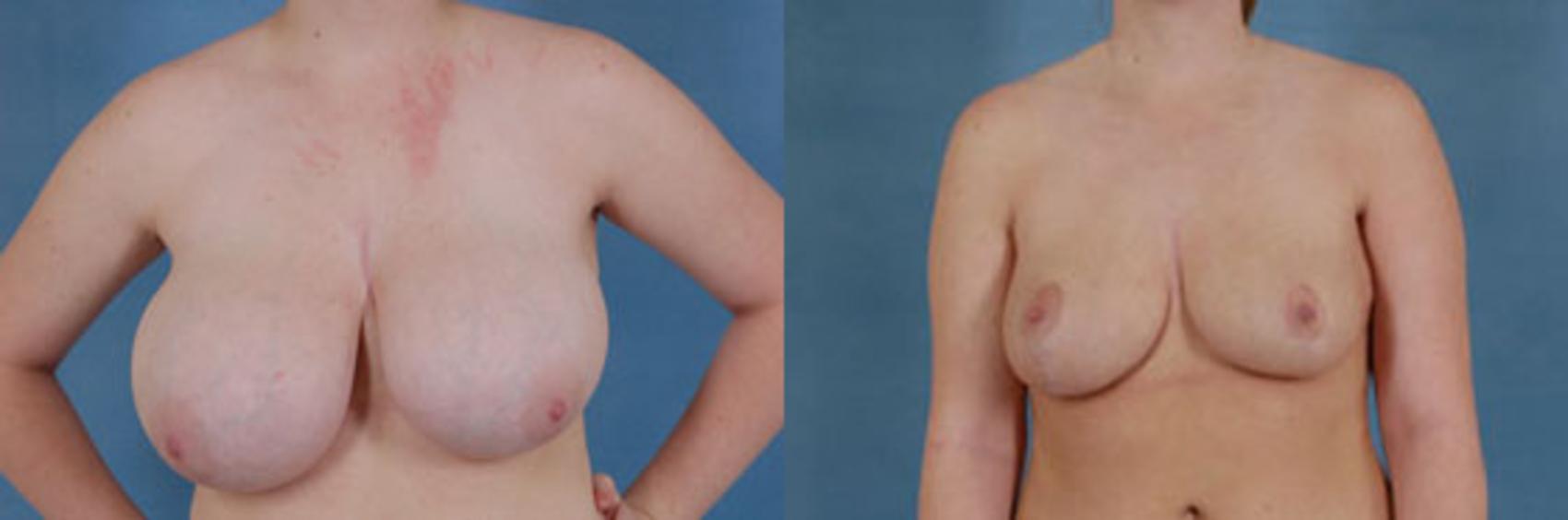 Before & After Breast Reduction Case 181 View #1 View in Tallahassee, FL