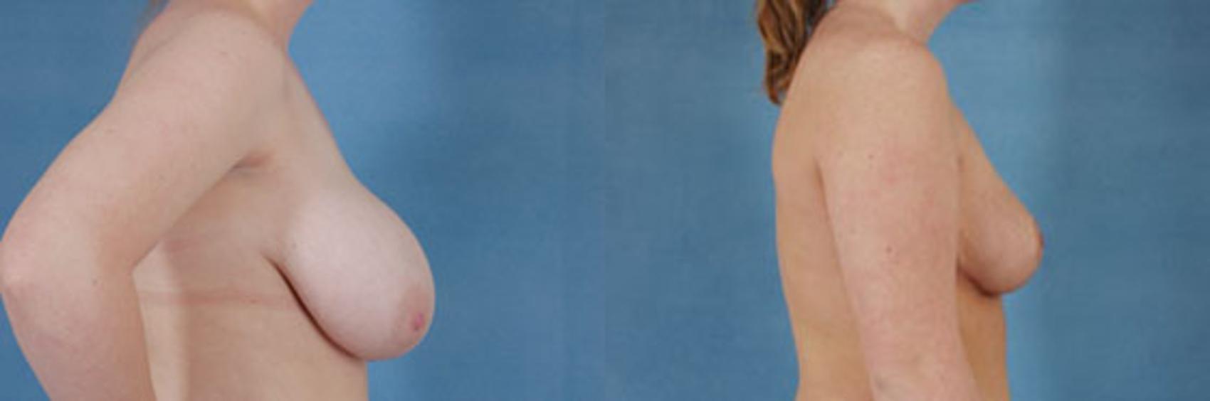 Before & After Breast Reduction Case 181 View #2 View in Tallahassee, FL
