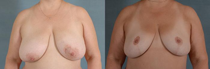 Before & After Breast Reduction Case 182 View #1 View in Tallahassee, FL