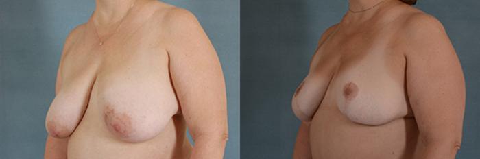 Before & After Breast Reduction Case 182 View #2 View in Tallahassee, FL
