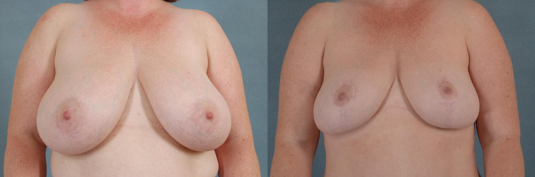 Before & After Breast Reduction Case 183 View #1 View in Tallahassee, FL