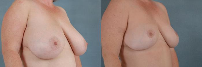 Before & After Breast Reduction Case 183 View #2 View in Tallahassee, FL