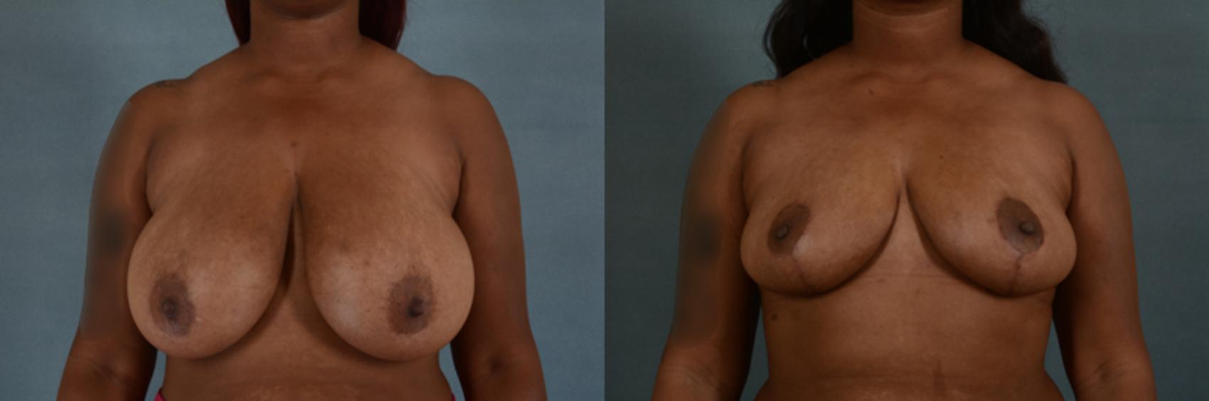Before & After Breast Reduction Case 184 View #1 View in Tallahassee, FL