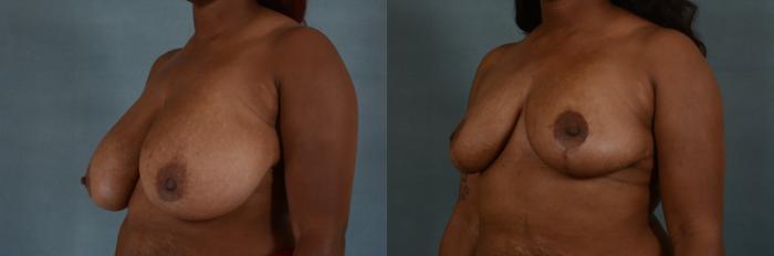 Before & After Breast Reduction Case 184 View #2 View in Tallahassee, FL