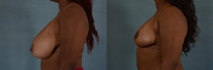 Before & After Breast Reduction Case 184 View #3 View in Tallahassee, FL