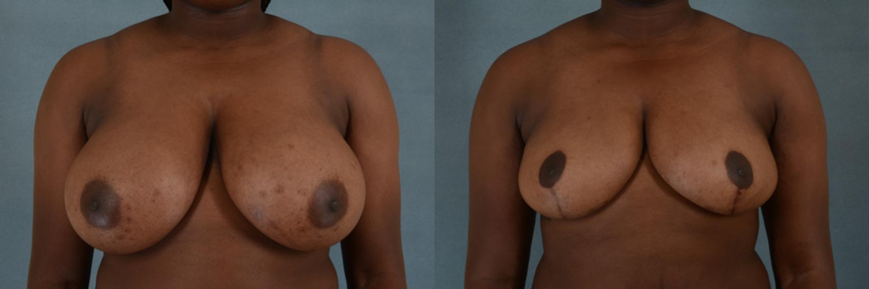 Before & After Breast Reduction Case 185 View #1 View in Tallahassee, FL