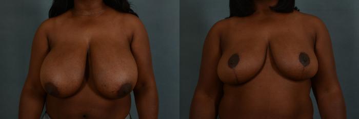 Before & After Breast Reduction Case 186 View #1 View in Tallahassee, FL