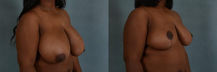 Before & After Breast Reduction Case 186 View #2 View in Tallahassee, FL