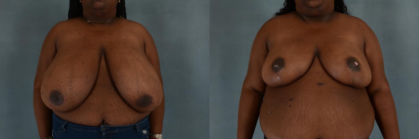 Before & After Breast Reduction Case 260 View #1 View in Tallahassee, FL