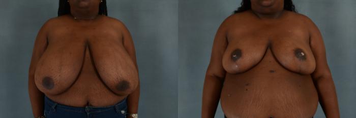 Before & After Breast Reduction Case 260 View #1 View in Tallahassee, FL