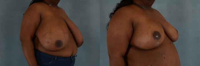 Before & After Breast Reduction Case 260 View #2 View in Tallahassee, FL