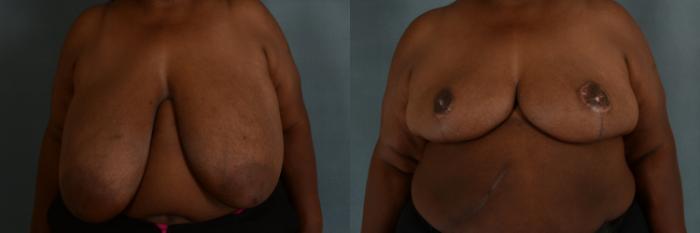 Before & After Breast Reduction Case 273 View #1 View in Tallahassee, FL