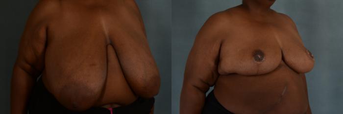 Before & After Breast Reduction Case 273 View #2 View in Tallahassee, FL