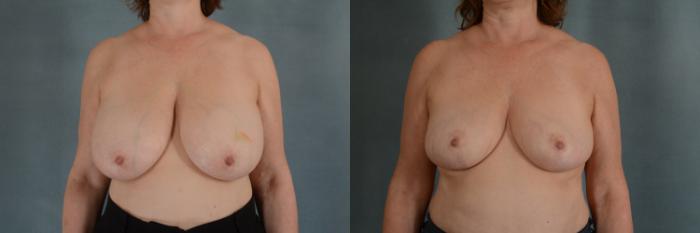 Before & After Breast Reduction Case 304 View #1 View in Tallahassee, FL