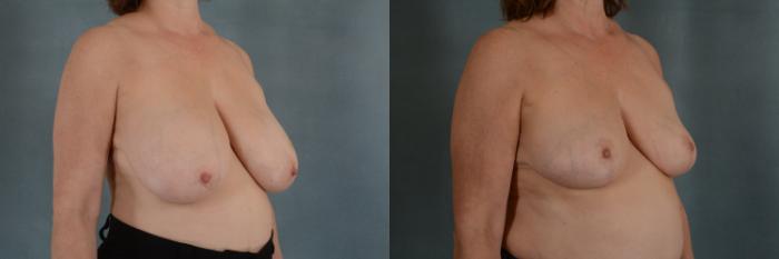 Before & After Breast Reduction Case 304 View #2 View in Tallahassee, FL