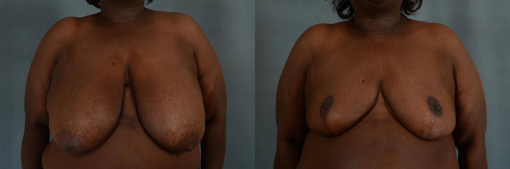Before & After Breast Reduction Case 306 View #1 View in Tallahassee, FL