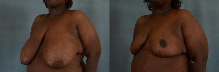 Before & After Breast Reduction Case 306 View #2 View in Tallahassee, FL