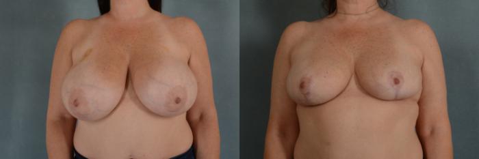 Before & After Breast Reduction Case 308 View #1 View in Tallahassee, FL
