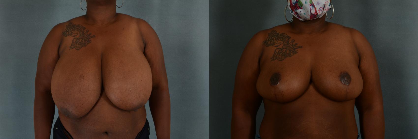 Before & After Breast Reduction Case 318 View #1 View in Tallahassee, FL