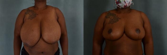 Before & After Breast Reduction Case 318 View #1 View in Tallahassee, FL