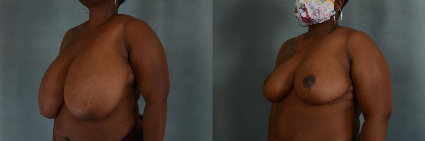 Before & After Breast Reduction Case 318 View #2 View in Tallahassee, FL