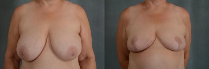 Before & After Breast Reduction Case 327 View #1 View in Tallahassee, FL