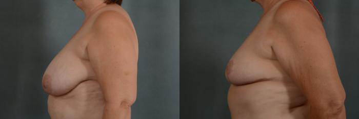 Before & After Breast Reduction Case 327 View #2 View in Tallahassee, FL