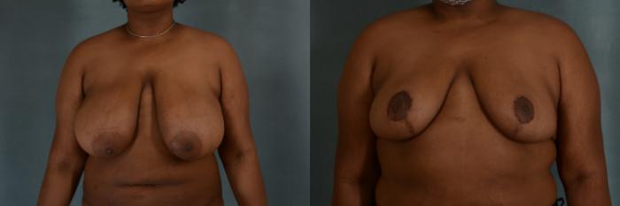 Before & After Breast Reduction Case 338 View #1 View in Tallahassee, FL