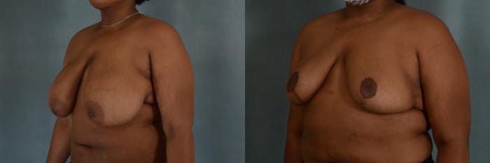Before & After Breast Reduction Case 338 View #3 View in Tallahassee, FL