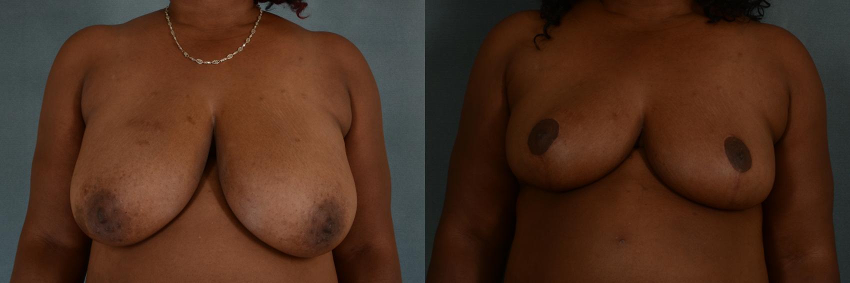 Before & After Breast Reduction Case 352 View #1 View in Tallahassee, FL