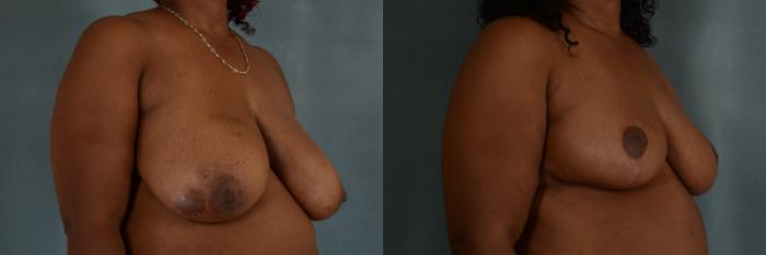 Before & After Breast Reduction Case 352 View #2 View in Tallahassee, FL