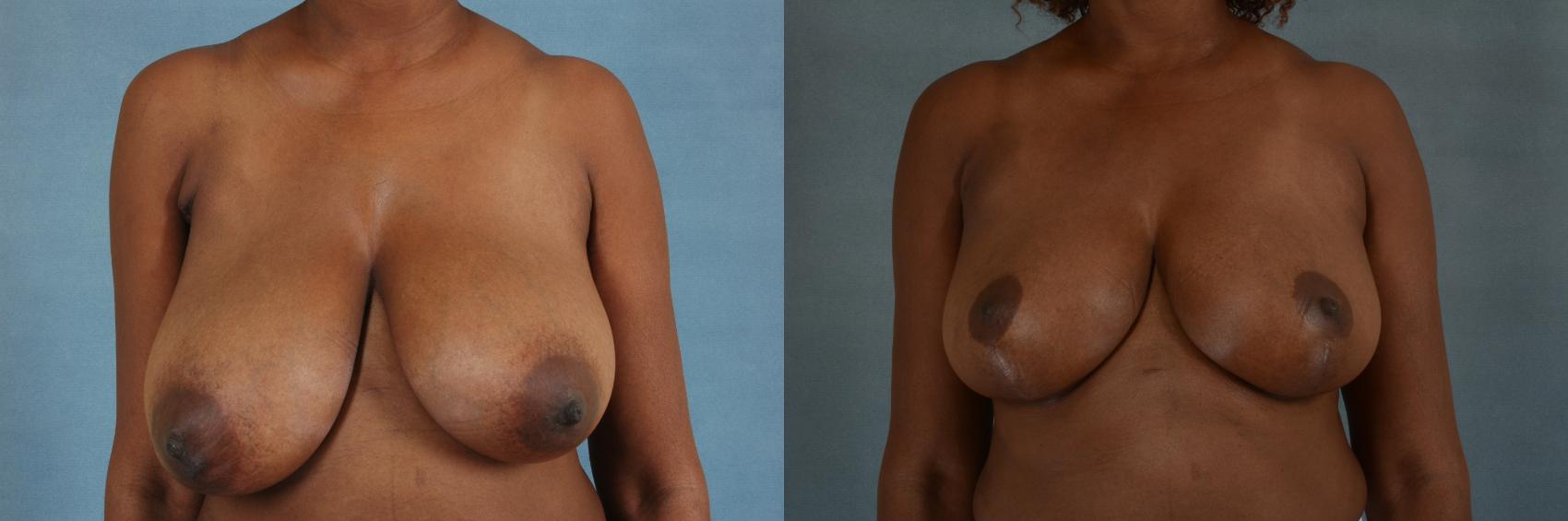 Before & After Breast Reduction Case 371 View #1 View in Tallahassee, FL