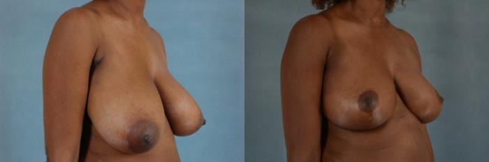 Before & After Breast Reduction Case 371 View #2 View in Tallahassee, FL