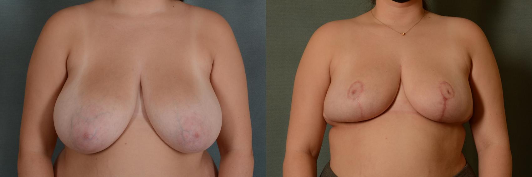 Before & After Breast Reduction Case 385 View #1 View in Tallahassee, FL