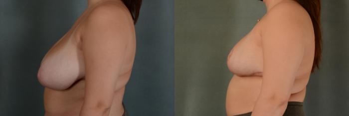 Before & After Breast Reduction Case 385 View #2 View in Tallahassee, FL