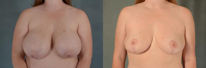Before & After Breast Reduction Case 386 View #1 View in Tallahassee, FL