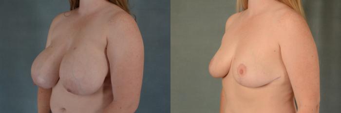 Before & After Breast Reduction Case 386 View #2 View in Tallahassee, FL