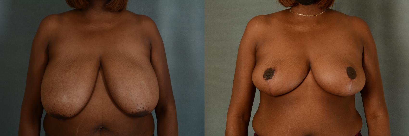 Before & After Breast Reduction Case 392 View #1 View in Tallahassee, FL