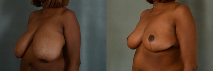 Before & After Breast Reduction Case 392 View #2 View in Tallahassee, FL