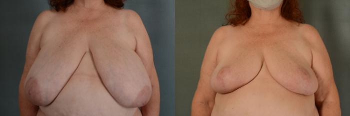 Before & After Breast Reduction Case 398 View #1 View in Tallahassee, FL