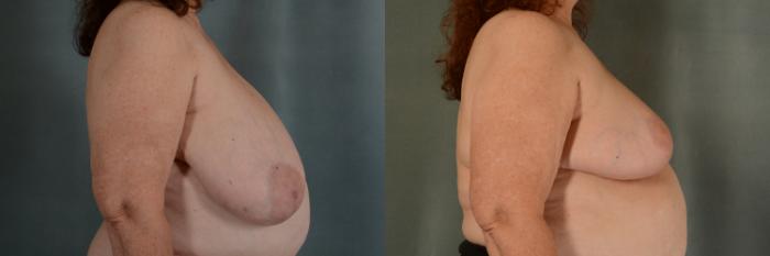 Before & After Breast Reduction Case 398 View #2 View in Tallahassee, FL