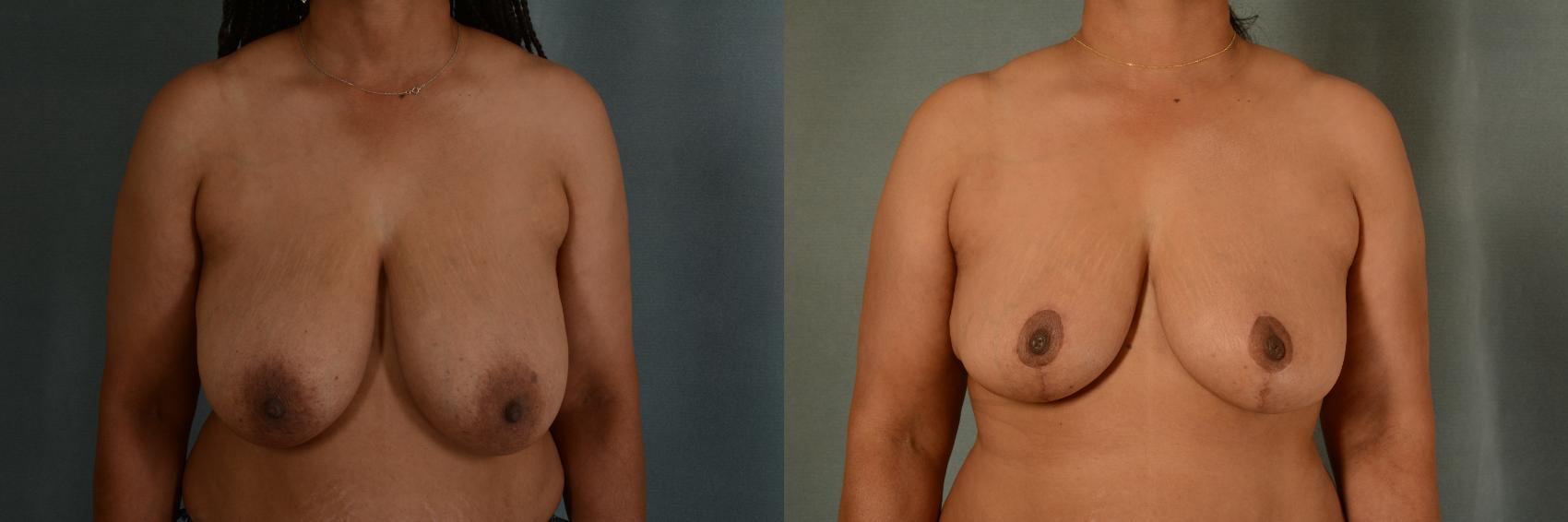 Before & After Breast Reduction Case 414 View #1 View in Tallahassee, FL