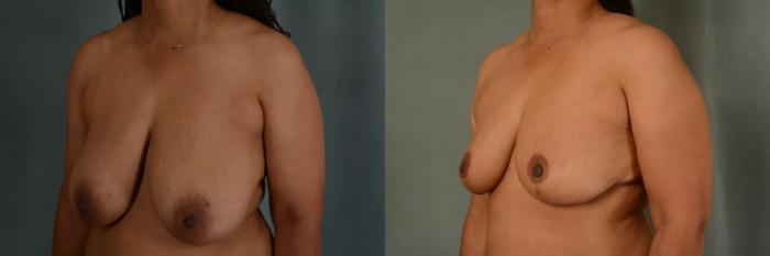 Before & After Breast Reduction Case 414 View #2 View in Tallahassee, FL