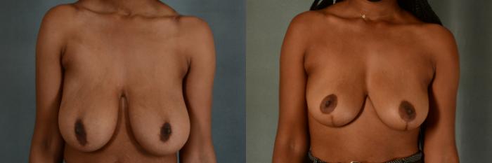 Before & After Breast Reduction Case 417 View #1 View in Tallahassee, FL