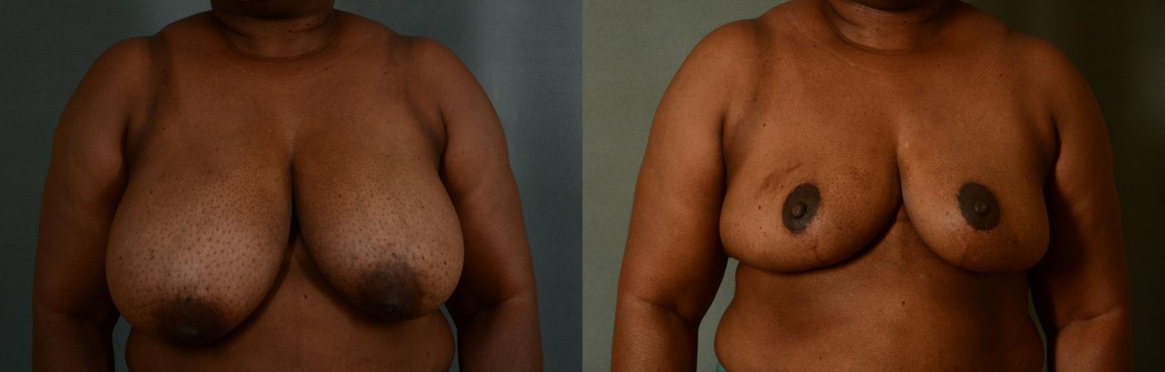 Before & After Breast Reduction Case 425 View #1 View in Tallahassee, FL